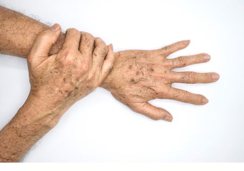 Age Spots: How to Treat and Prevent Them for Glowing, Even Skin After 50