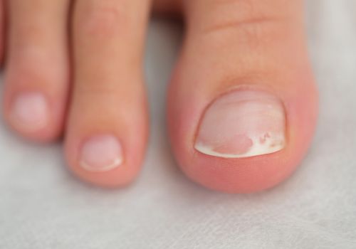 toenail with slight discoloration showing early nail changes foot care after 40