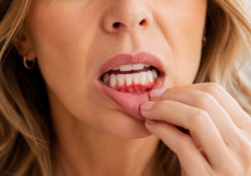 Close-up of a woman checking irritated and bleeding gums during menopause.